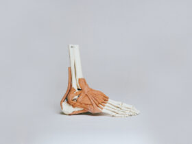neuroma di morton o metatarsalgia di morton